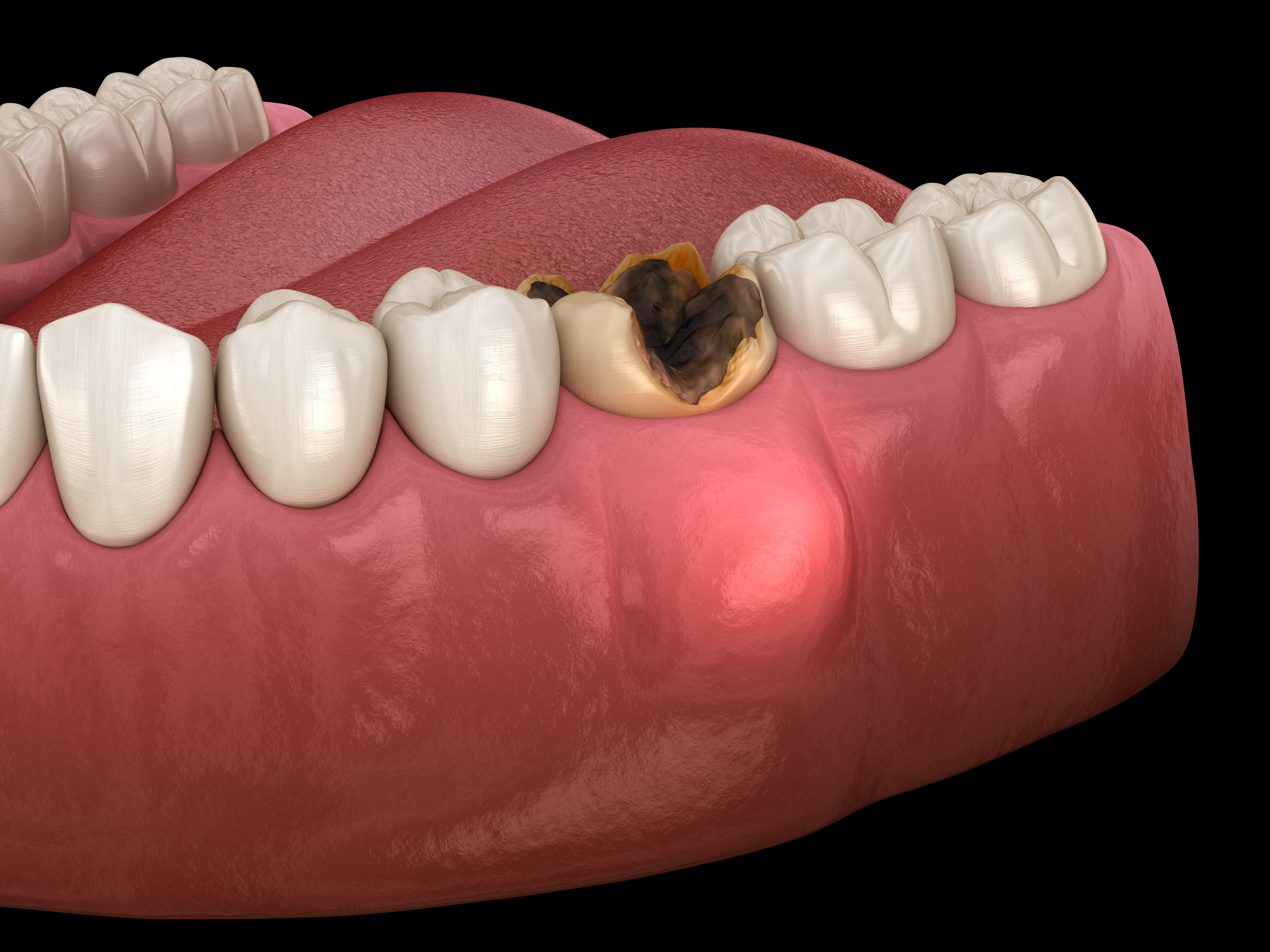 Dental Abscess