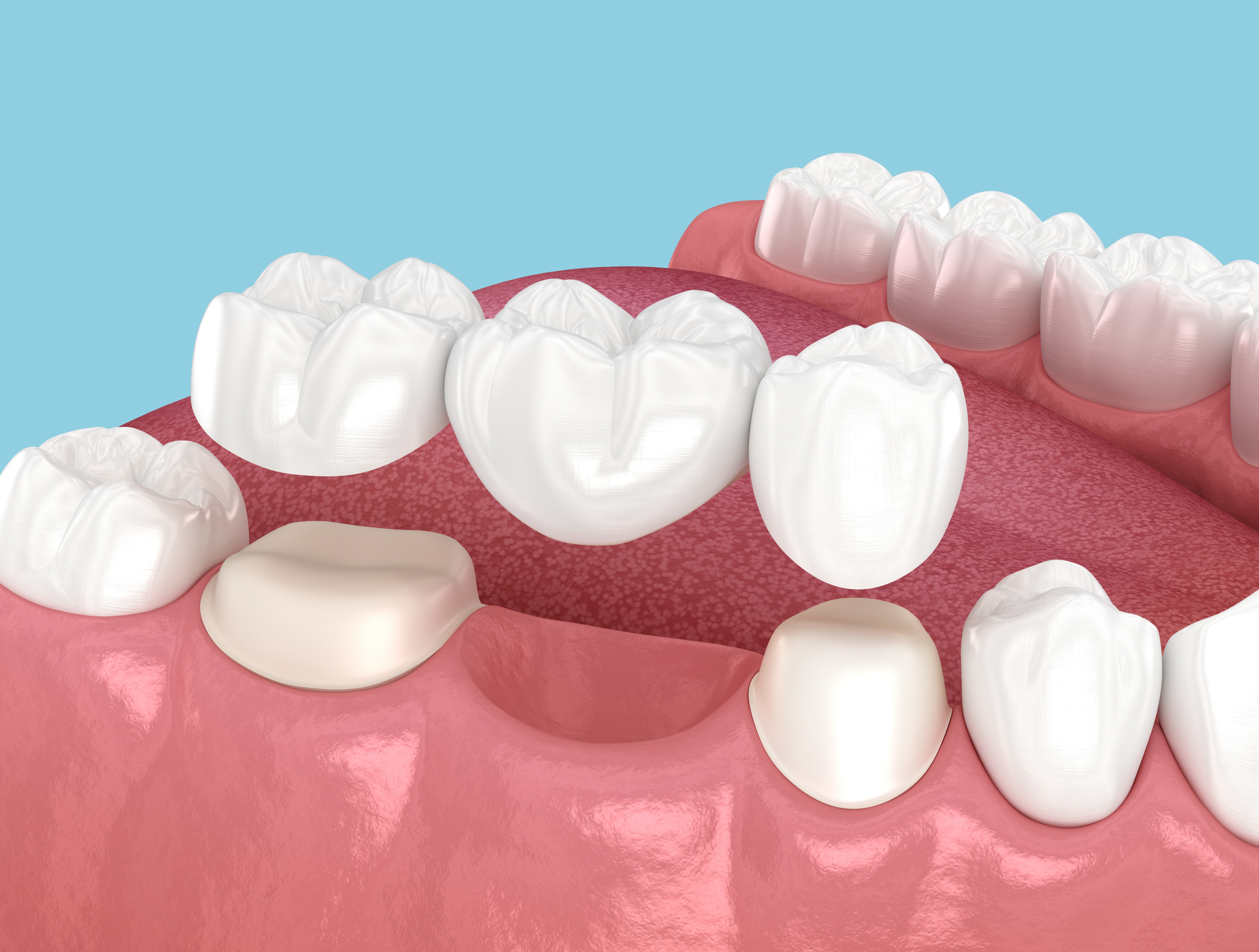 Dental Bridges
