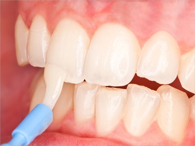 Fluoride Treatments