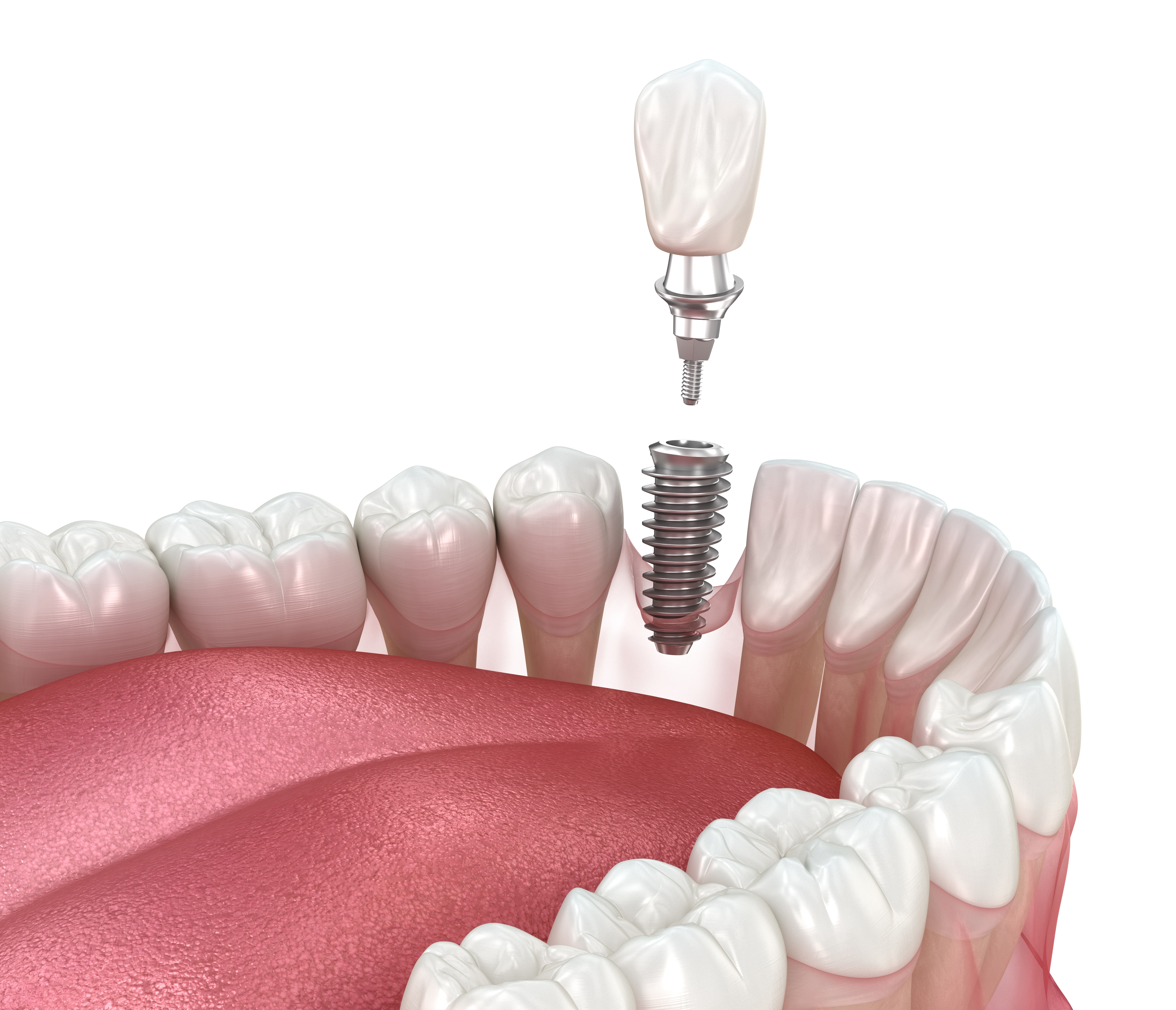Dental Implants